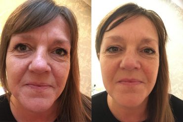 Zone Face Lift