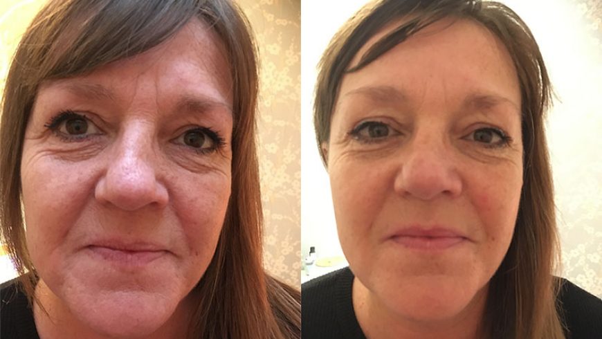 Zone Face Lift